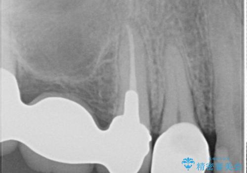 拡大鏡にて虫歯を除去。精度の高いセラミッククラウンの治療後