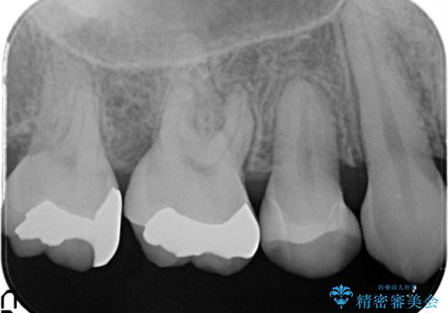 笑ったら銀歯が見える。 セラミックインレーによる治療の治療後