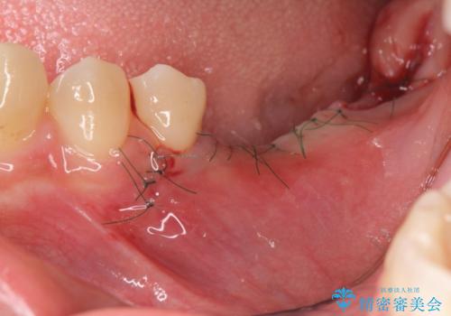 臼歯の噛み合わせをインプラントを用いて回復するの治療中