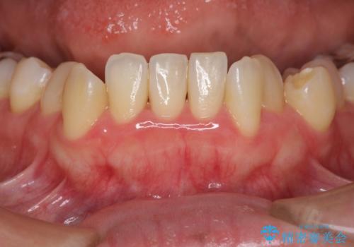 歯周初期治療の重要性の症例 治療後