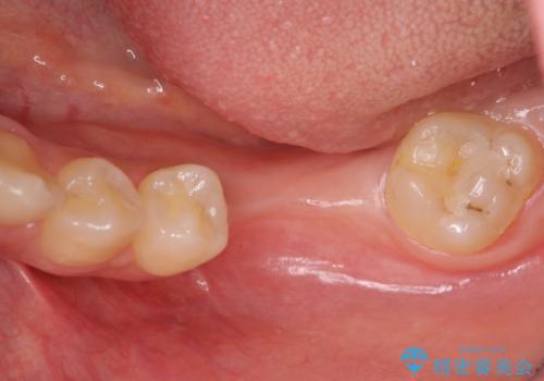 臼歯の噛み合わせをインプラントを用いて回復するの治療前