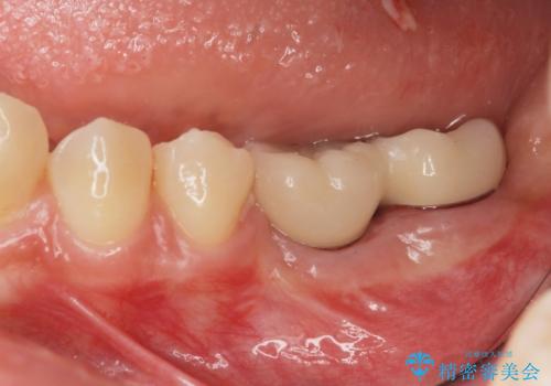 臼歯の噛み合わせをインプラントを用いて回復するの症例 治療後