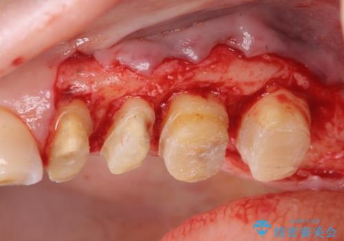放置してしまった深い虫歯の治療の治療中