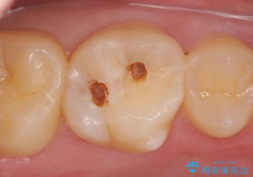 検診による初期虫歯の早期発見・早期治療