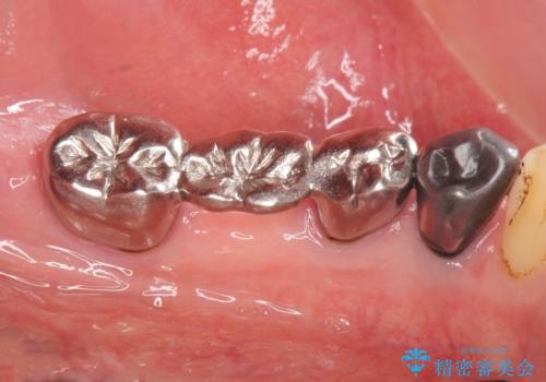 老朽化したブリッジのやりかえの治療前