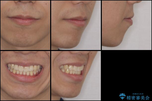 インビザラインで整った口元にの治療後(顔貌)