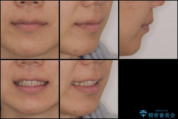 インビザライン矯正とインプラント補綴 深い咬み合わせと奥歯の欠損治療の治療後(顔貌)