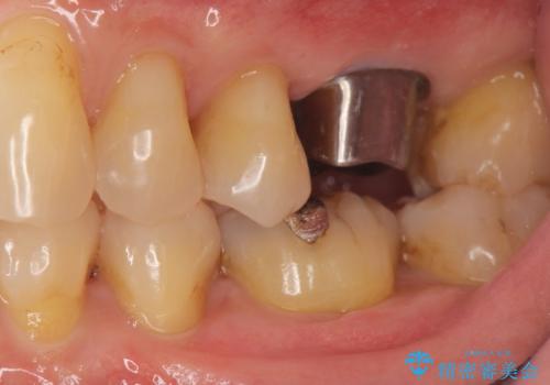 奥歯の欠損　インプラントによる咬合機能回復の治療中