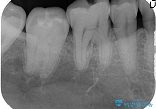 治療したむし歯の再治療。セラミックにしたい!の治療前