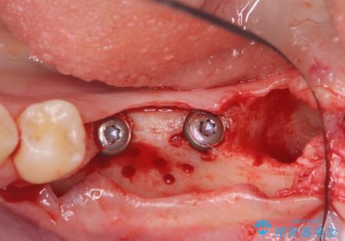 臼歯の噛み合わせをインプラントを用いて回復するの治療中