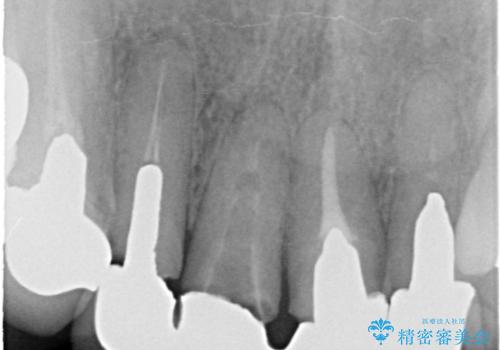上の前歯の根元が黒い 根の治療を含めたセラミック再治療の治療前