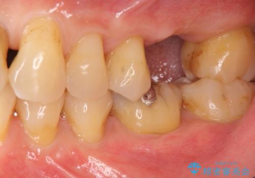 奥歯の欠損 インプラントによる咬合機能回復の治療前