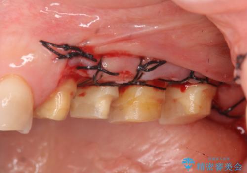 放置してしまった深い虫歯の治療の治療中