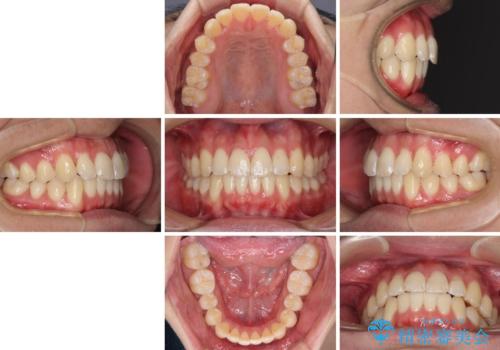 インビザラインで整った口元にの治療後