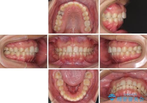 インビザライン矯正とインプラント補綴 深い咬み合わせと奥歯の欠損治療の治療後