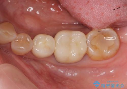 臼歯　咬合の再構成の治療後