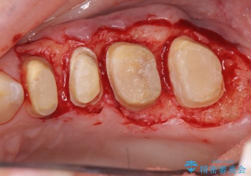 放置してしまった深い虫歯の治療の治療中