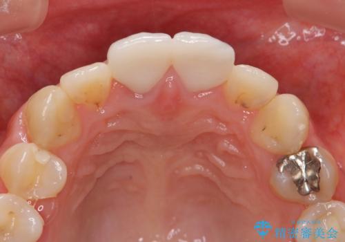 前歯 審美改善セラミック治療の治療後
