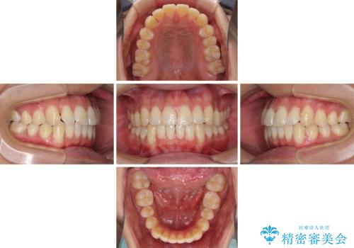インビザラインで整った口元にの治療中