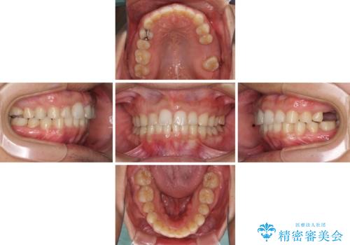 インビザライン矯正とインプラント補綴　深い咬み合わせと奥歯の欠損治療の治療中