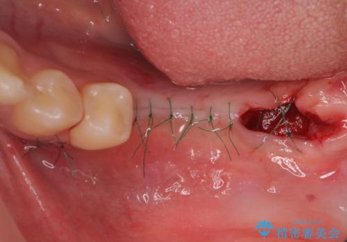 臼歯の噛み合わせをインプラントを用いて回復するの治療中