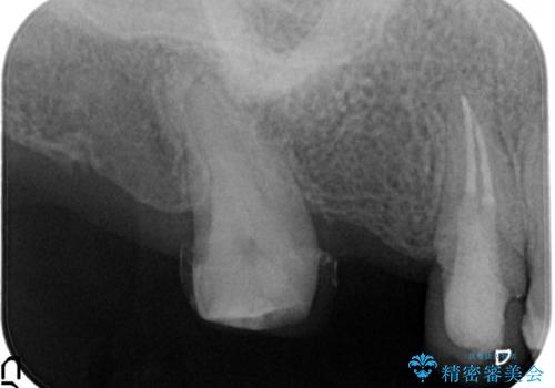 奥歯のオールセラミックブリッジの治療前