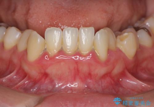 歯周初期治療の重要性の症例 治療前
