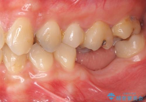 臼歯の噛み合わせをインプラントを用いて回復するの治療前