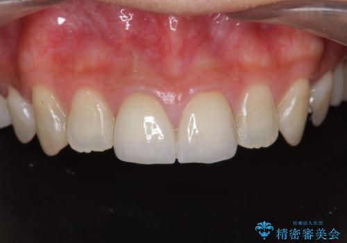 前歯　審美改善セラミック治療の症例 治療後