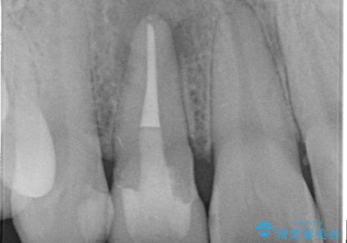 前歯が痛い。根管治療~セラミッククラウンの治療後
