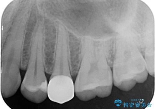 割れた歯を引っ張り出す　右上と左上の虫歯治療の治療後