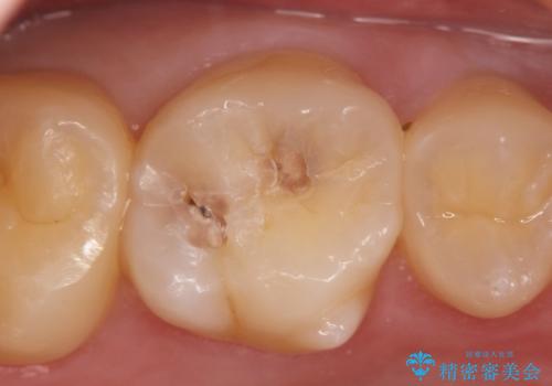 検診による初期虫歯の早期発見・早期治療の治療前