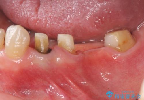 老朽化したブリッジのやりかえの治療中