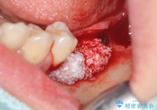臼歯の噛み合わせをインプラントを用いて回復するの治療中