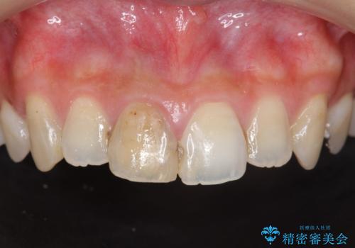 前歯　審美改善セラミック治療の症例 治療前