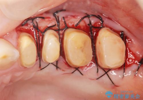 放置してしまった深い虫歯の治療の治療中