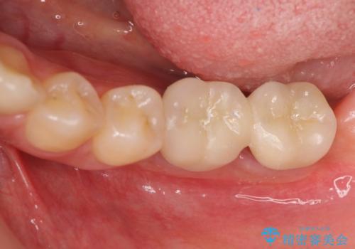 臼歯の噛み合わせをインプラントを用いて回復するの治療後