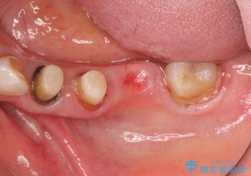 老朽化したブリッジのやりかえの治療中