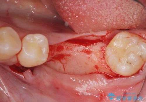 臼歯の噛み合わせをインプラントを用いて回復するの治療中