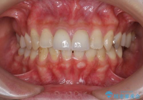 前歯　審美改善セラミック治療の治療後