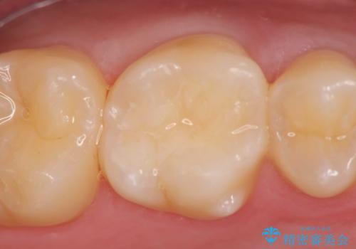 検診による初期虫歯の早期発見・早期治療の症例 治療後