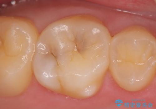 検診による初期虫歯の早期発見・早期治療の症例 治療前