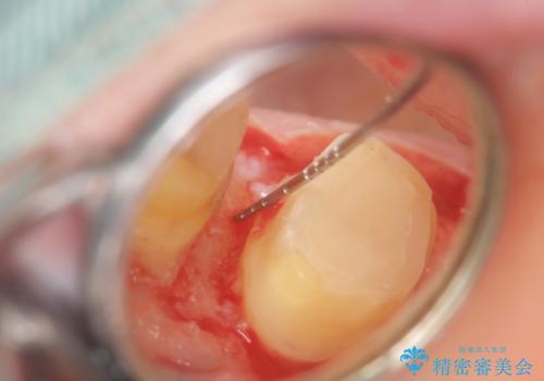 放置してしまった深い虫歯の治療の治療中