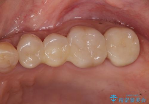臼歯　咬合の再構成の治療後
