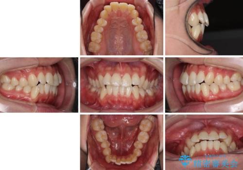 インビザラインで整った口元にの治療前