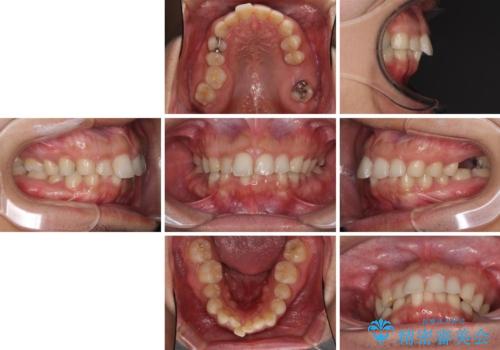 インビザライン矯正とインプラント補綴　深い咬み合わせと奥歯の欠損治療の治療前