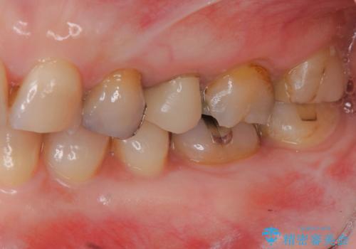放置してしまった深い虫歯の治療の治療前