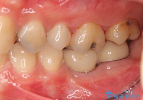 臼歯の噛み合わせをインプラントを用いて回復するの治療後