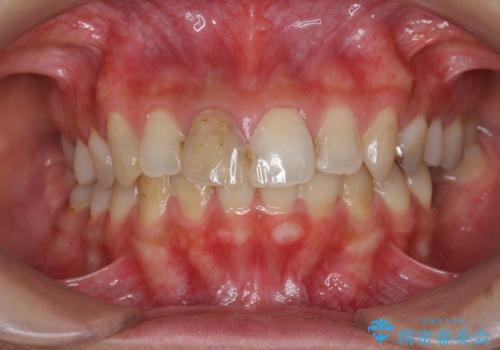 前歯　審美改善セラミック治療の治療前