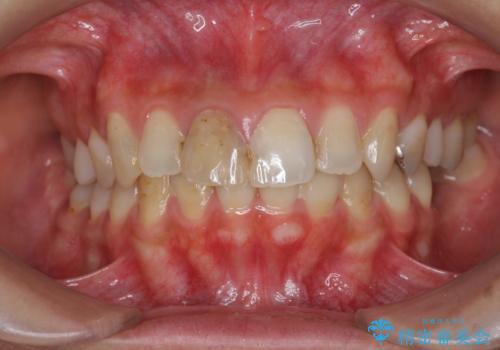 前歯 審美改善セラミック治療の治療前